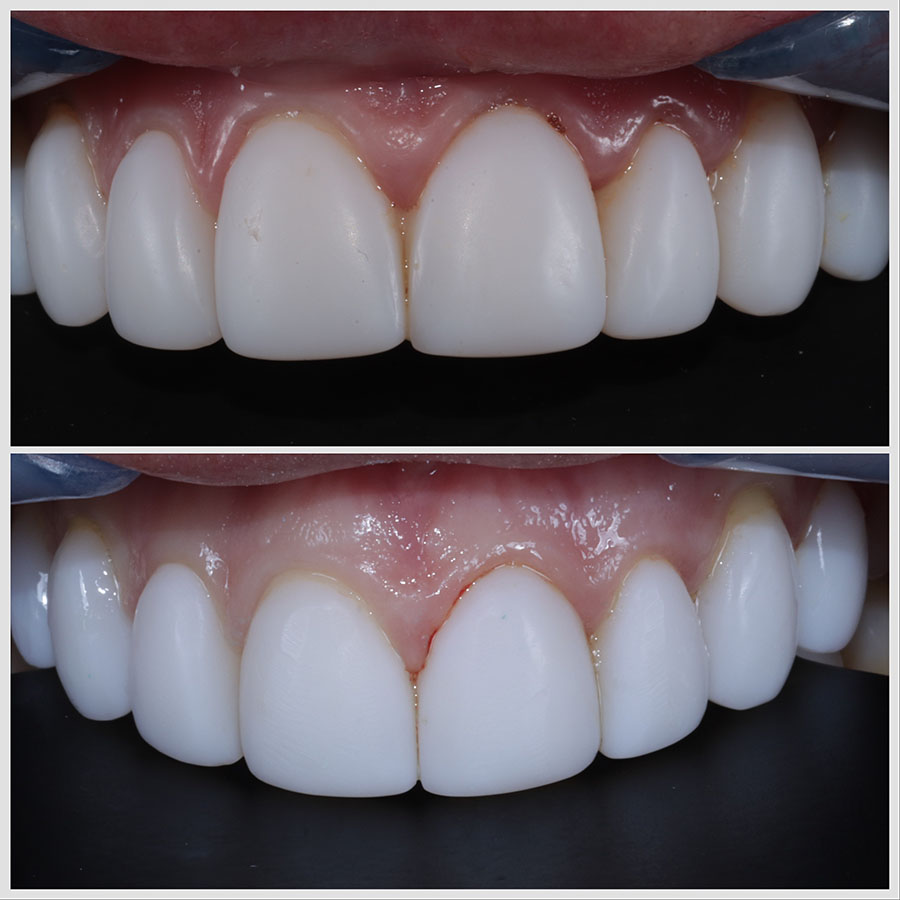 Composite Bonding Refresh