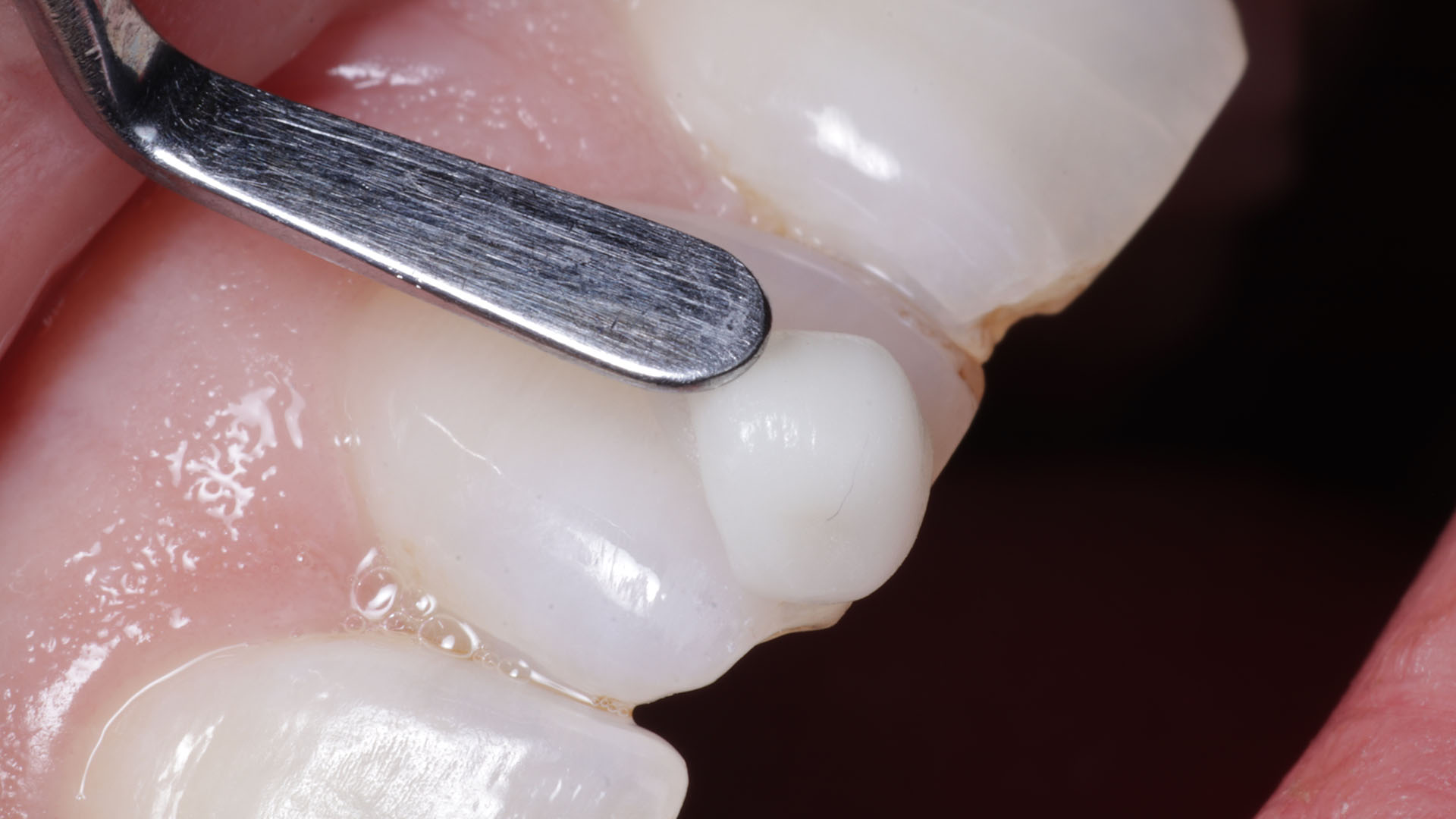 Composite Bonding